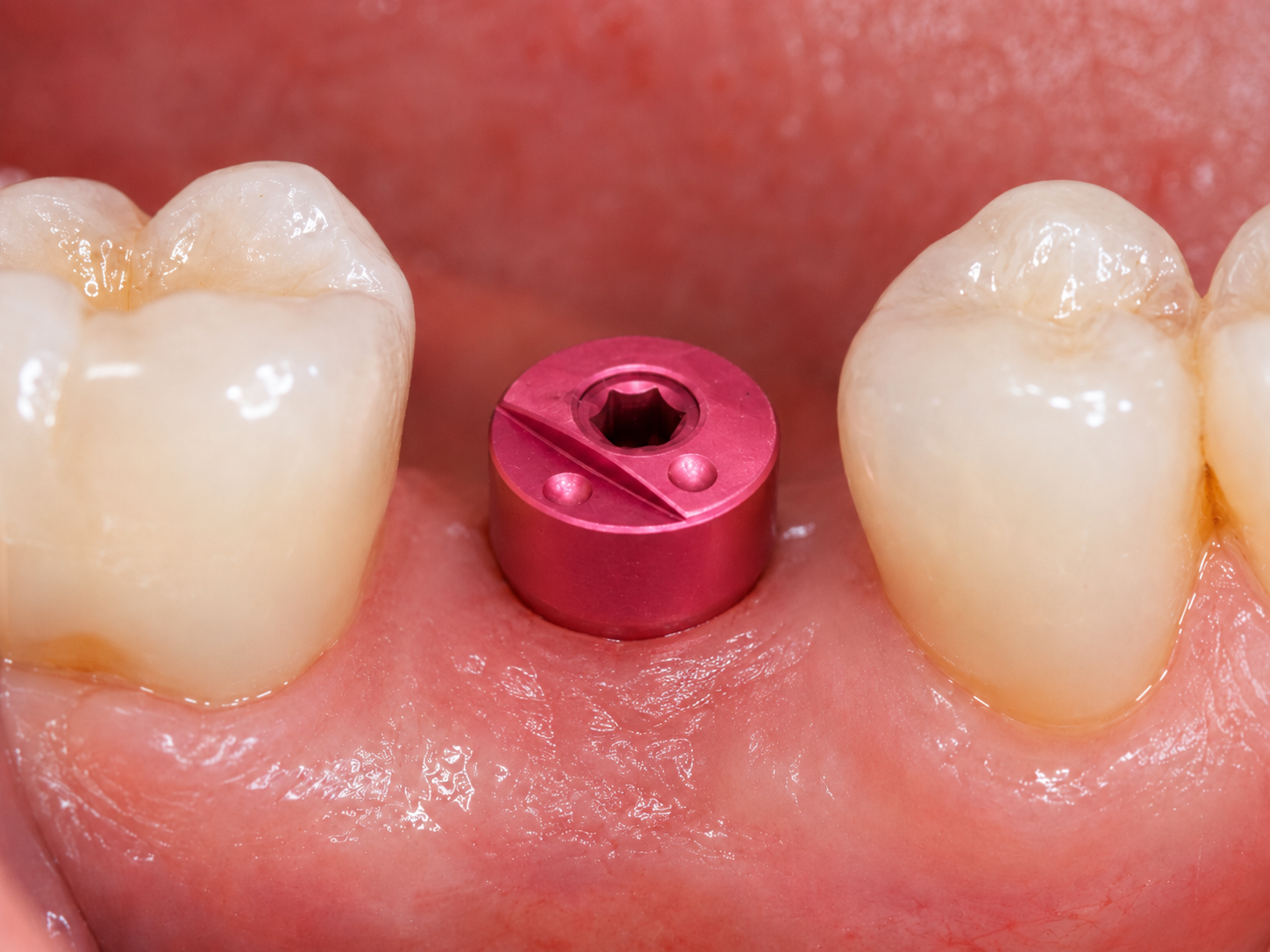 ZimVie Encode Einheilaufbau mit dem einzigartigen kodierten Oberflächenmuster zur digitalen Implantatidentifikation